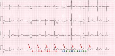 Case Report: Bradycardia in neonatal lupus: differential diagnosis between atrioventricular block and premature atrial contractions with block